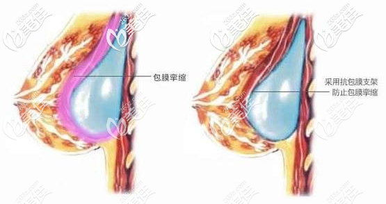 泰國yanhee醫(yī)院隆胸技術(shù)優(yōu)勢