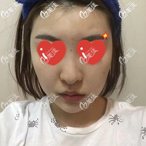 術(shù)前的我大鼻頭 術(shù)前的我大鼻頭