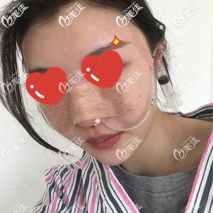 做完鼻綜合手術(shù)后即刻有變化 做完鼻綜合手術(shù)后即刻有變化