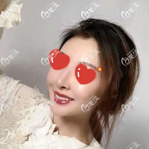 鼻綜合術(shù)后10天感覺難看一定是還沒看到效果，給你看我做硅膠+耳軟骨術(shù)后40多天真實記錄