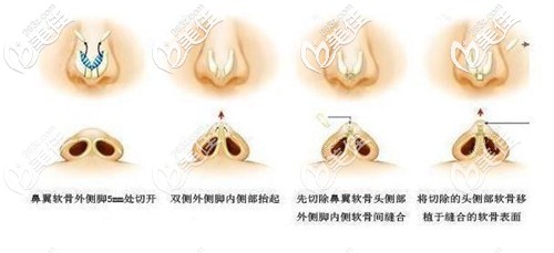 咸福實(shí)醫(yī)生做鼻綜合手術(shù)過程 咸福實(shí)醫(yī)生做鼻綜合手術(shù)過程