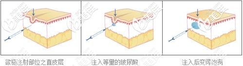 孔華斌醫(yī)生做注射玻尿酸填充過程 孔華斌醫(yī)生做注射玻尿酸填充過程