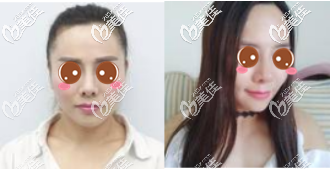 重慶華美下頜角整形真人案例