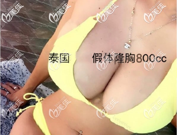 泰國假體隆胸800cc圖片