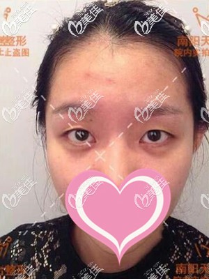 做手術(shù)前的照片 做手術(shù)前的照片