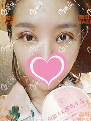 開眼角雙眼皮手術(shù)后第二天 開眼角雙眼皮手術(shù)后第二天