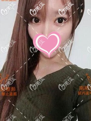 雙眼皮開眼角手術(shù)恢復(fù)一個半月 雙眼皮開眼角手術(shù)恢復(fù)一個半月