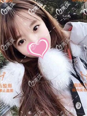 忍不住分享眼間距寬做全切雙眼皮手術(shù)+開眼角恢復(fù)過程圖的效果