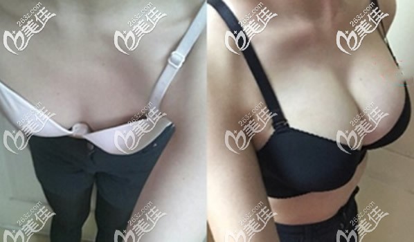 韓國ID醫(yī)院假體隆胸對比圖