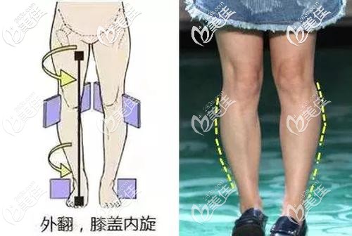 小腿外翻事例圖