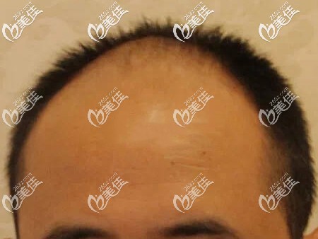 頭頂A型脫發(fā)示例圖 頭頂A型脫發(fā)示例圖