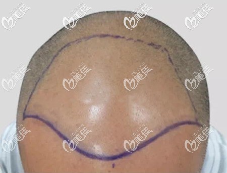 頭頂加密植發(fā)3000單位設(shè)計圖 頭頂加密植發(fā)3000單位設(shè)計圖