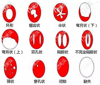 處女膜的所有形態(tài)