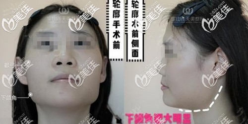 術(shù)前下頜角顴骨寬大 術(shù)前下頜角顴骨寬大