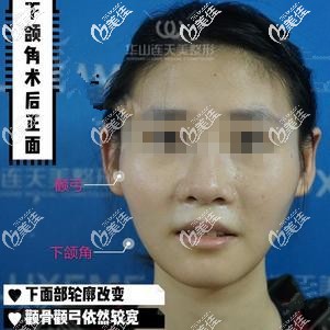 先做下頜角之后的效果 先做下頜角之后的效果