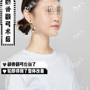 然后再做顴骨后的效果 然后再做顴骨后的效果