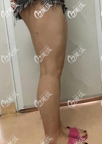 大腿吸脂前脂肪堆積 大腿吸脂前脂肪堆積