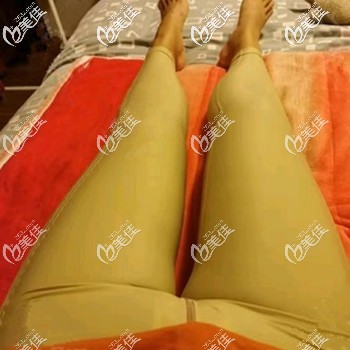 大腿吸脂后會有輕微的疼痛感 大腿吸脂后會有輕微的疼痛感