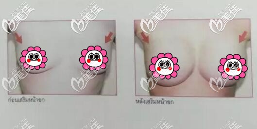 泰國yanhee然禧整形醫(yī)院假體隆胸真人案例