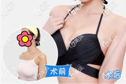 乳房下垂矯正效果對(duì)比