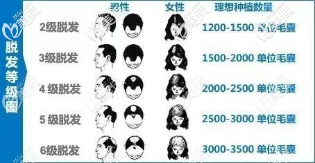 各級別脫發(fā)種植毛囊數(shù)量圖 各級別脫發(fā)種植毛囊數(shù)量圖