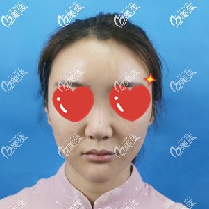 術前鼻頭大鼻翼寬的自己 術前鼻頭大鼻翼寬的自己