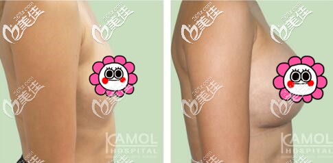 泰國KAMOL咖蒙醫(yī)院假體隆胸真人案例