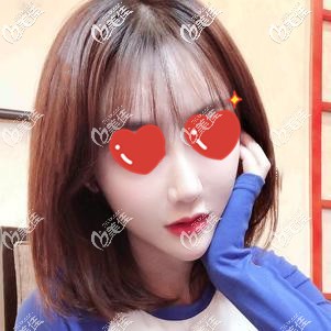 硅膠隆鼻恢復(fù)過程分享：有人說做完假體4個月山根晃動，但我術(shù)后3個月并沒有出現(xiàn)這情況啊