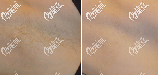 冰點脫毛案例圖 冰點脫毛案例圖