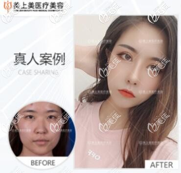 成都美上美隆鼻案例 成都美上美隆鼻案例