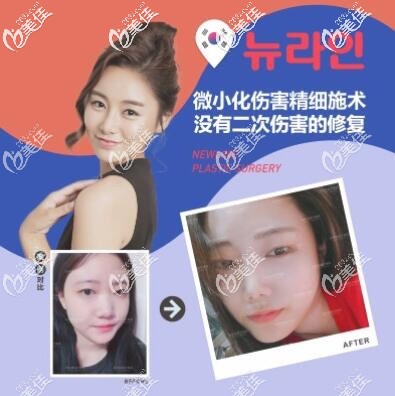 成都紐萊茵鼻綜合案例 成都紐萊茵鼻綜合案例