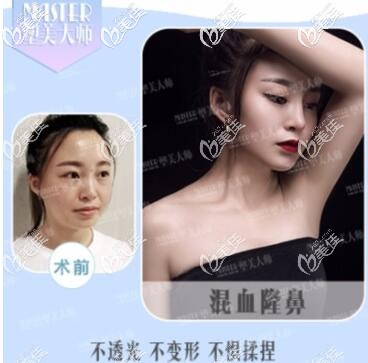 成都塑美大師混血隆鼻案例 成都塑美大師混血隆鼻案例