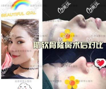 成都趙善軍博士肋軟骨隆鼻 成都趙善軍博士肋軟骨隆鼻