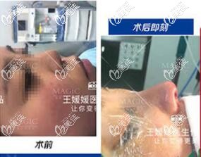 成都美極隆鼻案例 成都美極隆鼻案例