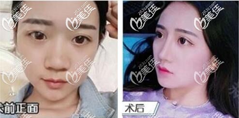 成都艾米麗高林隆鼻案例 成都艾米麗高林隆鼻案例