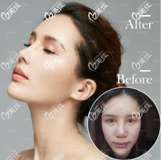 成都蜀尚蓉雅隆鼻 成都蜀尚蓉雅隆鼻