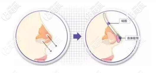 綜合隆鼻手術(shù)原理 綜合隆鼻手術(shù)原理