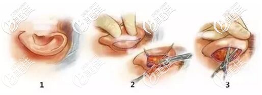 招風(fēng)耳矯正手術(shù)過程