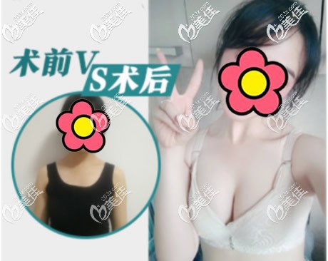 韓國(guó)蓓拉300cc毛面假體隆胸前后效果對(duì)比照片