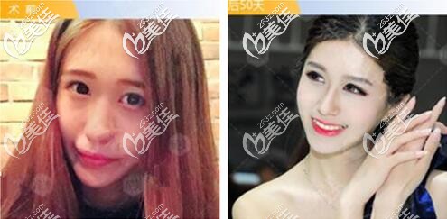 成都成美美容鼻綜合案例 成都成美美容鼻綜合案例