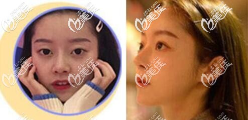 成都潤美玉之光隆鼻好的醫(yī)生是哪個 成都潤美玉之光隆鼻好的醫(yī)生是哪個