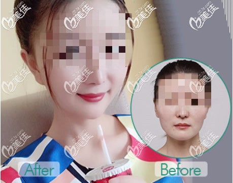 下頜角整形前后對比照片 下頜角整形前后對比照片