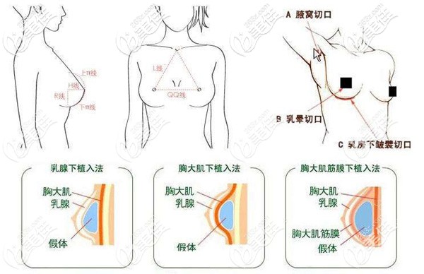 假體隆胸手術(shù)過(guò)程示意圖 假體隆胸手術(shù)過(guò)程示意圖