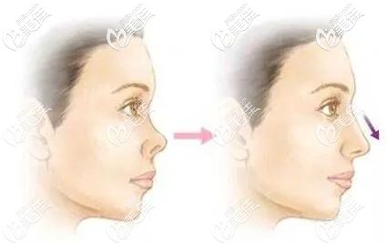 鼻假體取出后鼻子慢慢恢復到正常狀態(tài)