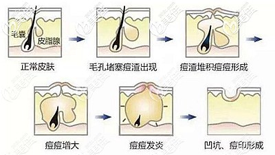 痘坑形成的原因