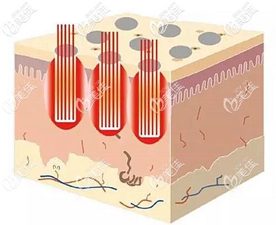 蜂巢皮秒可以去除痘坑痘印