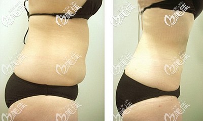腰腹吸脂后的效果