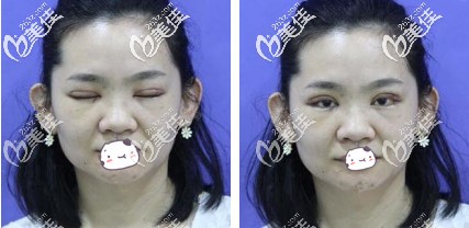 剛做完雙眼皮手術(shù)眼睛腫脹厲害