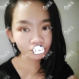 雙眼皮手術(shù)一周眼睛微腫脹