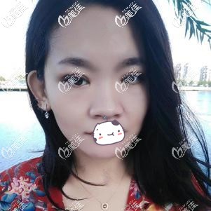 內(nèi)雙割出來的雙眼皮效果圖足以證明我選擇全切去除腫眼泡是正確的